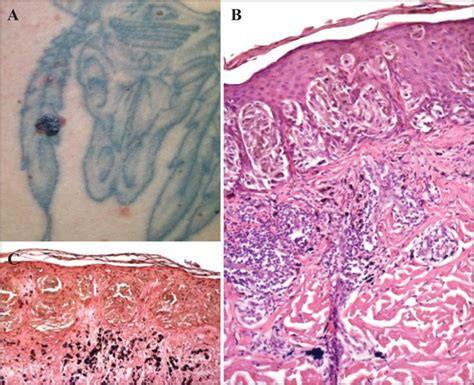 John Libbey Eurotext European Journal Of Dermatology Melanoma And Tattoos A Case Report And