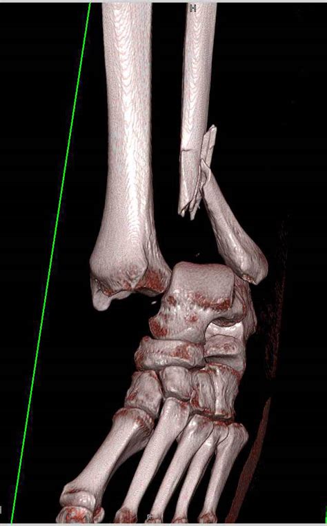 Fracturedislocation Of The Ankle Trauma Case Studies Ctisus Ct