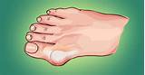 How To Get Gout Under Control