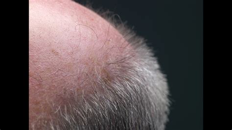 Hair Thinning Falling Out Getting Brittle A Trichologist Could Help