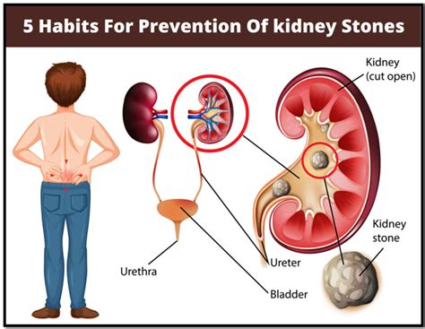 Habits For Prevention Of Kidney Stone Dr Suraj Lunavat