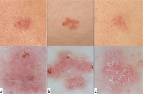Three Clinically Similar Erythematous And Slightly Scaly Flat Lesions