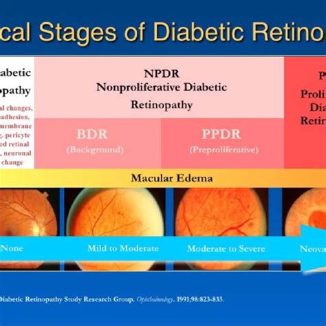 Stages Of Progression Of Diabetic Retinopathy Image Courtesy Of Lloyd
