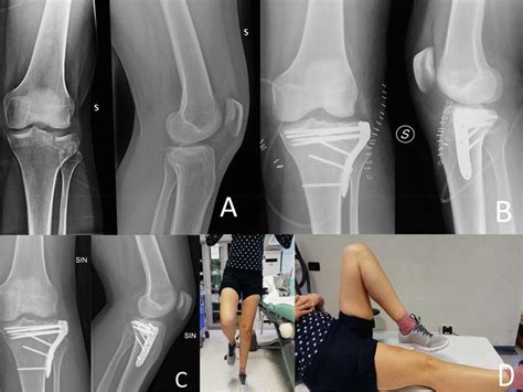 Tibial Plateau Fracture Schatzker Ii Treated With Orif Followed By