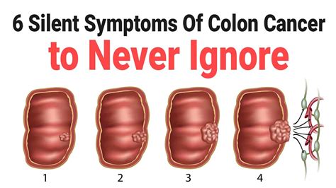 But there is chance of working also. 6 Silent Symptoms Of Colon Cancer to Never Ignore