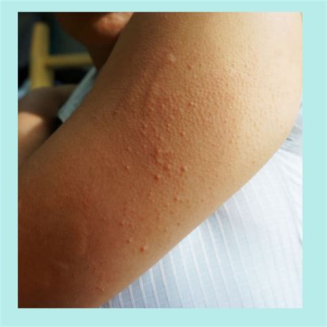 Skin Rashes Covid 19 Patients Tatva Skin Clinic Dermatology Clinic