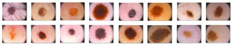 Common Nevus Images Extracted From Ph 2 And Isic 2019 Databases