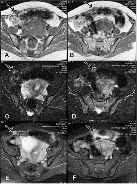 Magnetic Resonance Imaging Of The Pelvis Showing A Concomitant Download Scientific Diagram