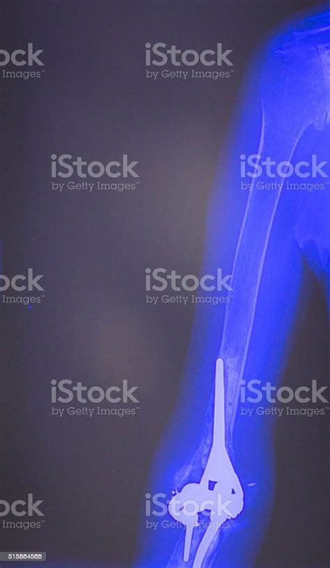 Elbow Arm Orthopedic Implant Xray Scan Stock Photo Download Image Now