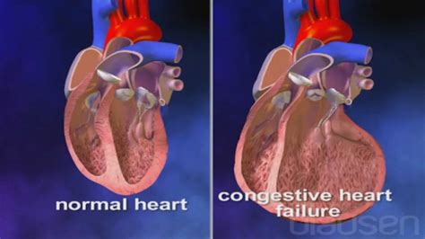 Congestive Heart Failure Conexion Florida