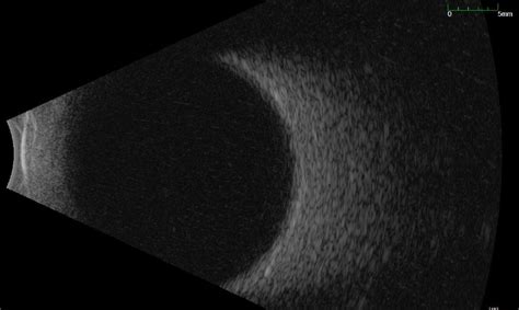 Ocular Ultrasonography Macula Retina Vitreous Center