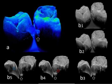 Promising Imaging Method For The Early Detection Of Dental Caries