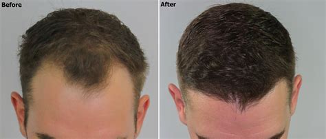 Temple Recession Restored With Fue Prp Combo Alviarmani Hair
