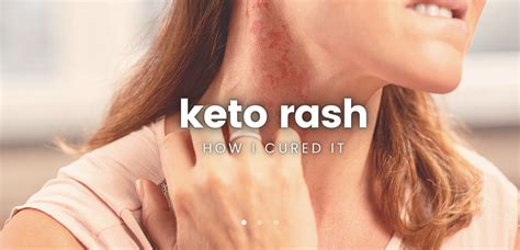 How I Cured My Keto Rash — Keto Twins