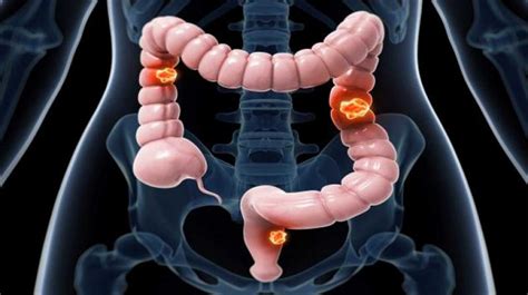 Doctors Stress On Need To Know Colorectal Cancer Symptoms