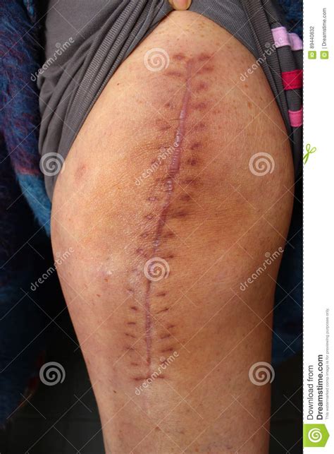 Total left knee replacement scar. Total Knee Replacement, Knee Surgery. Stock Photo - Image ...