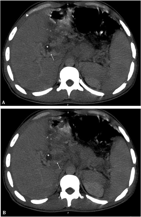 Axial Abdominal Ct Scan Images Demonstrating Enlarged Lymph Node Of