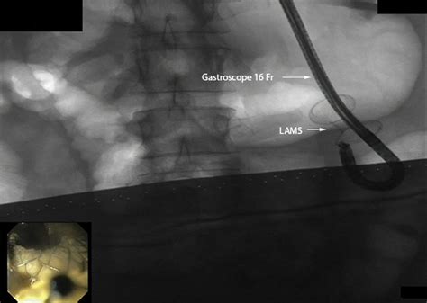 Fluoroscopic View Of The 16f Gastroscope Retroflexed Within The