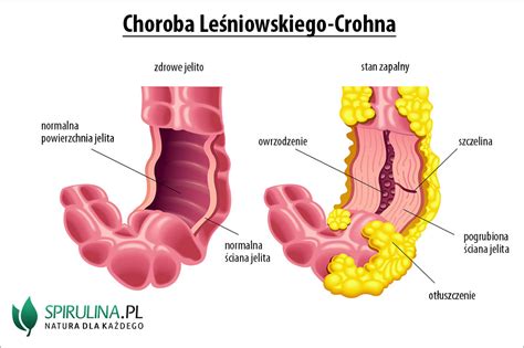Choroba Leśniowskiego Crohna Algi Spirulina I Chlorella