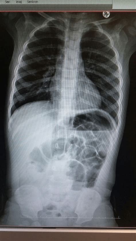 An Air Fluid Level In Abdominal X Ray As A Sign Of Intestinal