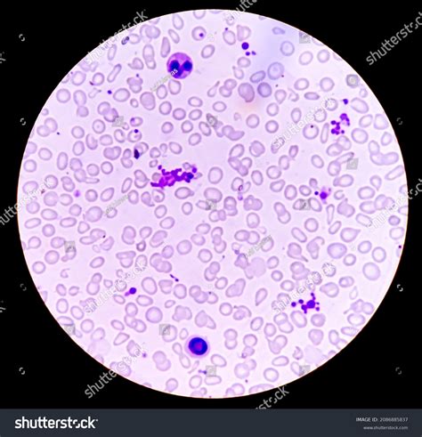 Hereditary Hemolytic Anemia Hemoglobin E Hbe ภาพสต็อก 2086885837