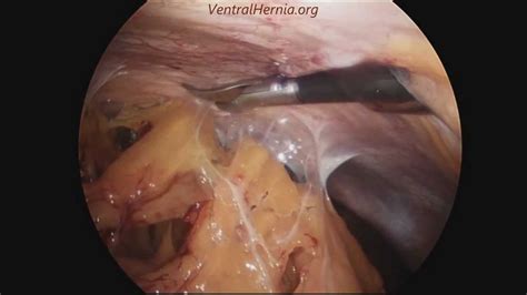 Ventral Hernia Surgery Youtube