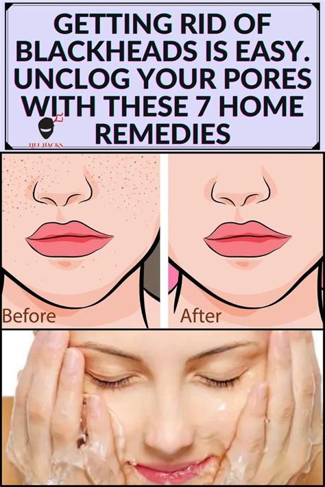 Getting Rid Of Blackheads Is Easy Unclog Your Pores With These 7 Home
