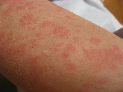 Types Of Skin Rashes And Symptoms With Pictures Beauty Health Tips