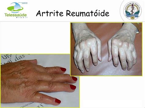 Ppt Artrite ReumatÓide Febre ReumÁtica Gota Powerpoint Presentation