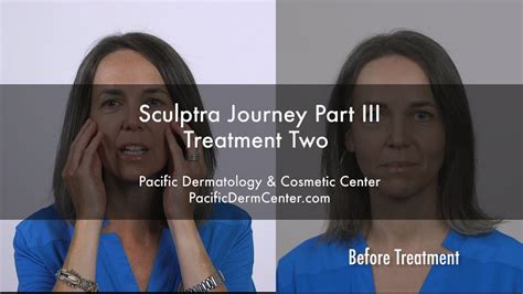 Sculptra Results To Lift And Tighten Face After 12 Weeks Seattlerenton