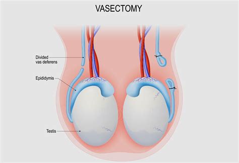Vasectomy is surgery to close off the tubes that carry sperm. Vasectomy
