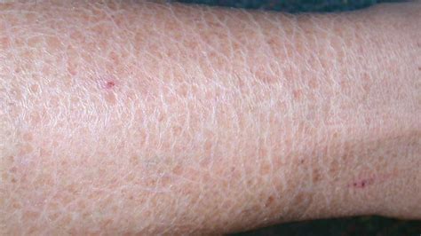 Dry Skin Rash On Arms