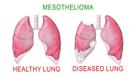 Mesothelioma Fund Mesothelioma Mesothelioma Healthy Lungs Lung Disease
