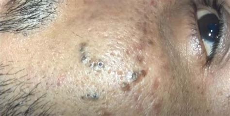 Lots Of Stubborn Blackheads On Face Removed New Pimple Popping Videos