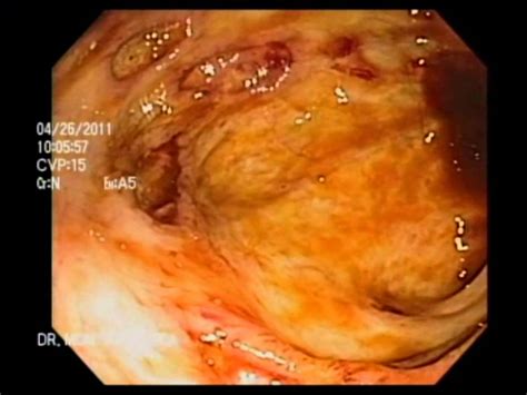 Maybe you would like to learn more about one of these? COLONOSCOPIA ENFERMEDAD DE CROHN 2 -NGELMED- - YouTube