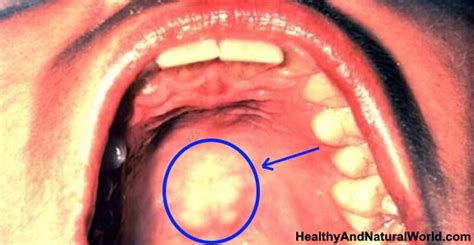 Abscess On Roof Of Mouth Pictures 12300 About Roof