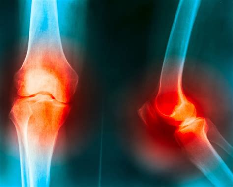 Distinct Trajectories Based On Pain In Knee And Hip Oa Identified