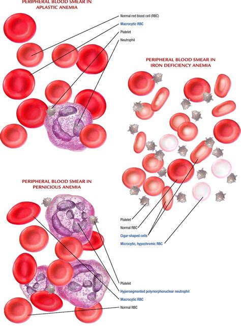 Anemia Atlas Of Pathophysiology 2 Edition