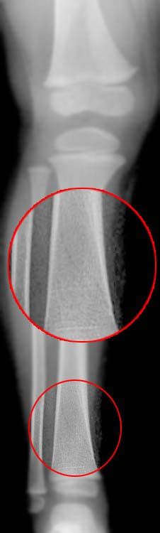 Toddler Fracture Wikidoc