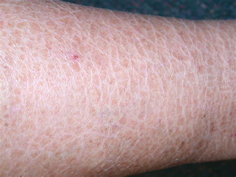Scaly Skin Causes And Dealing Ways New Health Advisor