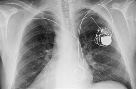 Medtronic Pacemaker X Ray