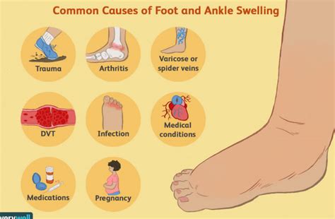 Whats Causing My Feet To Swell Almawi Limited The Holistic Clinic