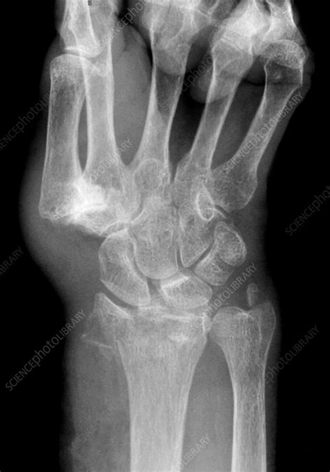 Wrist Fracture X Ray Stock Image C0393278 Science Photo Library