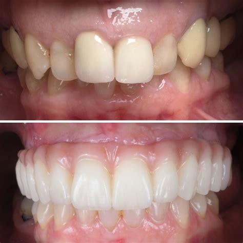+ simaria antes e depois das lentes de contato nos dentes (foto: Implantes Dentários - Caso Clínico 2 • Clínica Marisa Zenha