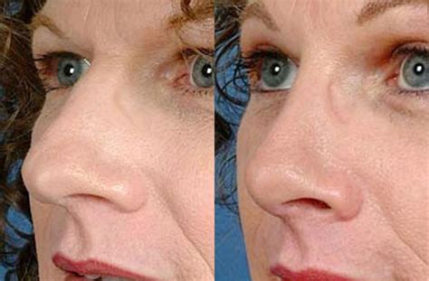 Nose Reshaping Before And After Photos Patient 99 Louisville