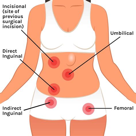 The ribs and sternum make up what is called the 'ribcage.' the ribcage protects the lungs, blood vessels, and heart, along with parts of the spleen, stomach, and kidneys from traumatic injury. Signs of hernia in women, MISHKANET.COM