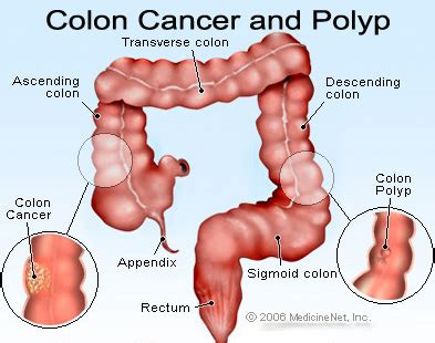 Metastatic colon cancer may also produce other symptoms depending on where in the body it has spread. Colon Cancer - Sign and Symptoms - Your Health