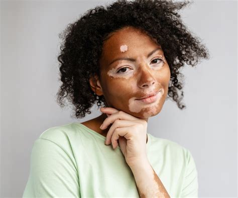 Leukoderma Vitiligo Skin Condition Este