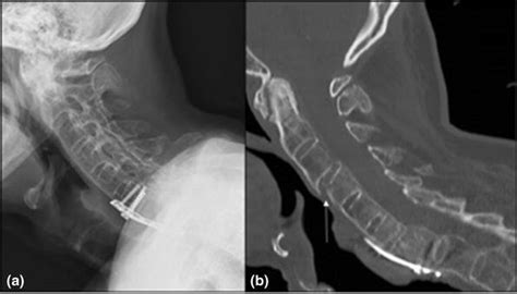 Cervical Fracture After Minor Trauma In A Patient With Long Standing