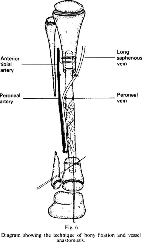 Figure From Free Vascularised Fibular Graft In The Treatment Of